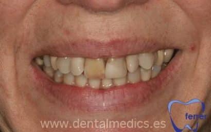 Antes