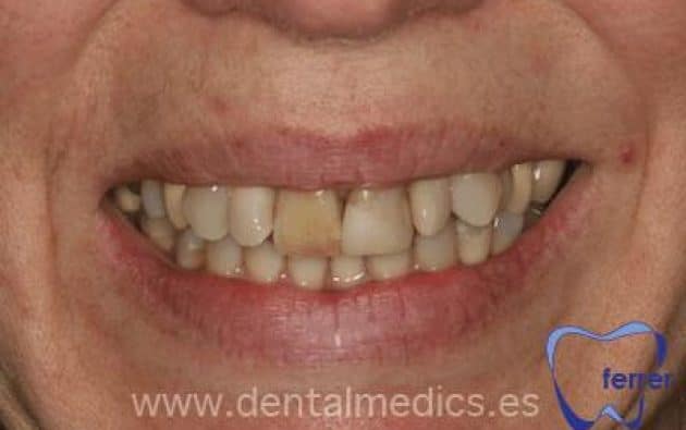 Antes