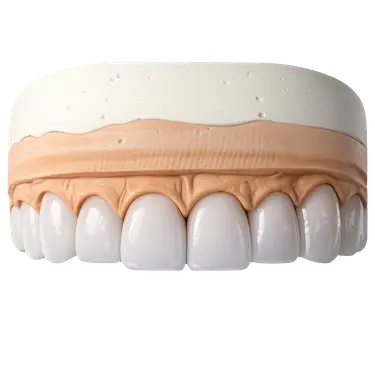 Carillas de disilicato de litio CAD CAM en dientes anteriores con alta estética dental