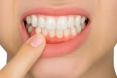 Paciente señalando encías inflamadas y enrojecidas como signo de gingivitis periodontal