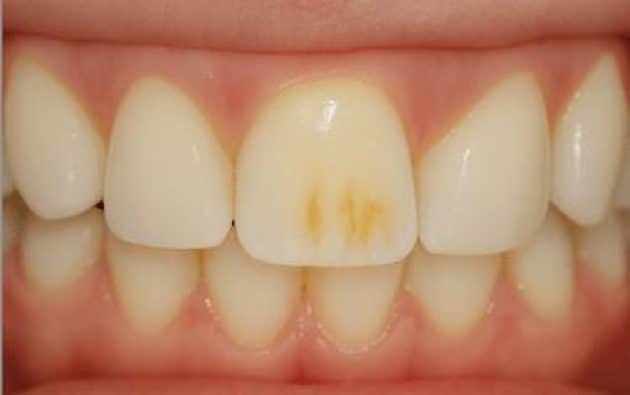 Antes