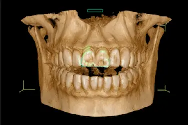 Imagen 3D de TAC dental para planificar tratamientos de ortodoncia