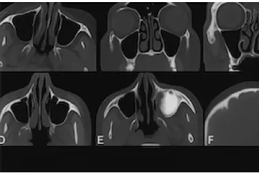 Cortes de TAC dental mostrando senos maxilares para planificación quirúrgica dental