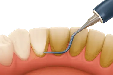 Limpieza dental profesional eliminando sarro acumulado que provoca mal sabor de boca