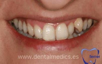 Antes