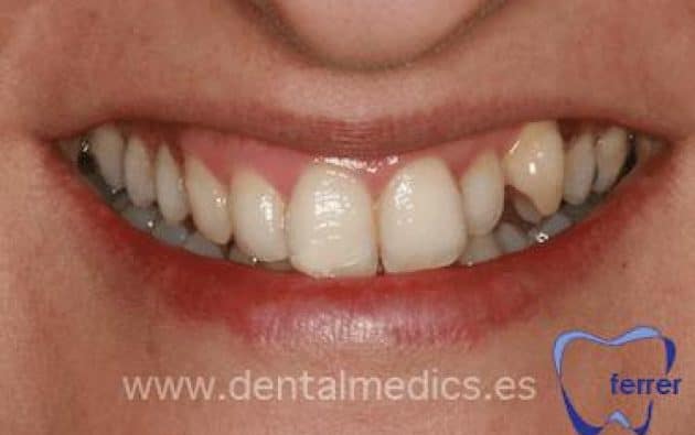 Antes