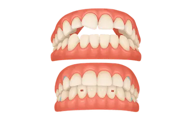 Antes y despu&eacute;s de tratamiento Invisalign en Madrid en Cl&iacute;nica Dental Dr. Ferrer
