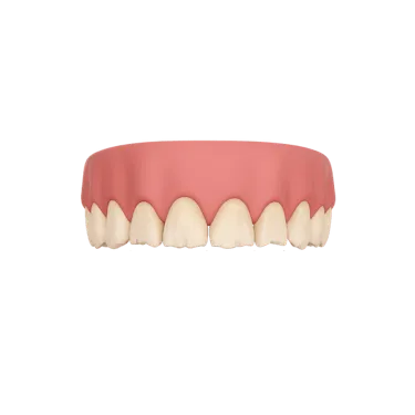 Desgaste dental moderado por bruxismo nocturno causado por apretar o rechinar los dientes