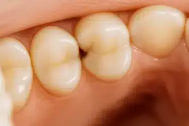 Caries interdental entre dos dientes contiguos, lesión oculta en el espacio interproximal