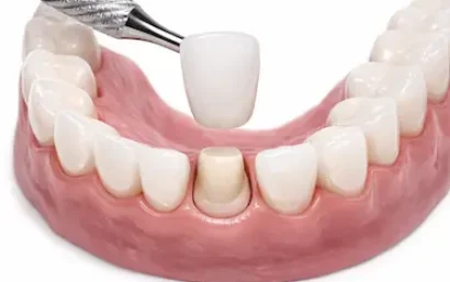 Colocación de corona dental sobre diente tallado en arcada inferior con encía rosada