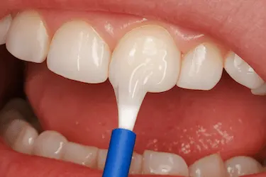 Aplicación de flúor dental para reducir la sensibilidad y fortalecer el esmalte