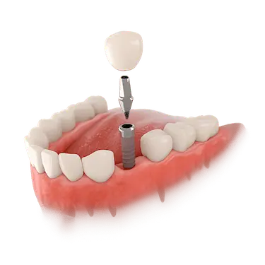 Implante dental de carga inmediata en la mandíbula inferior con corona atornillada
