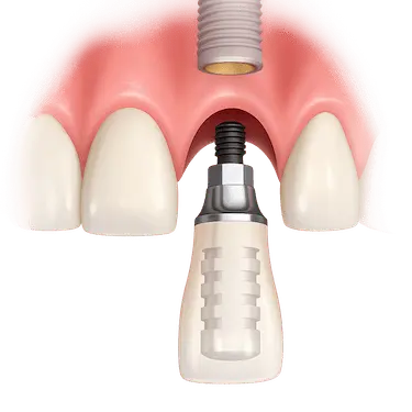 Colocación de implantes dentales en un día mediante la técnica de carga inmediata