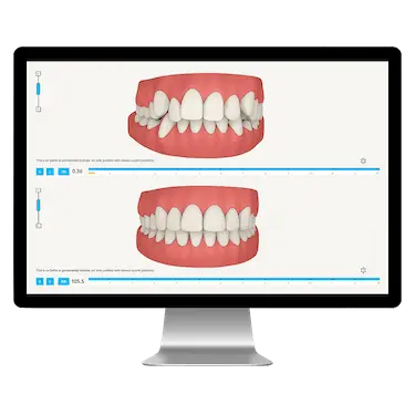 Planificación digital del tratamiento Invisalign con ClinCheck y visualización del movimiento dental