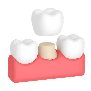 Corona dental colocada sobre un diente natural tallado junto a dos dientes sanos