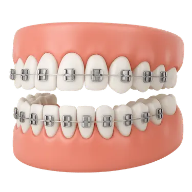 Brackets metálicos en dientes superiores e inferiores, ortodoncia tradicional en Madrid