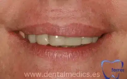 Después