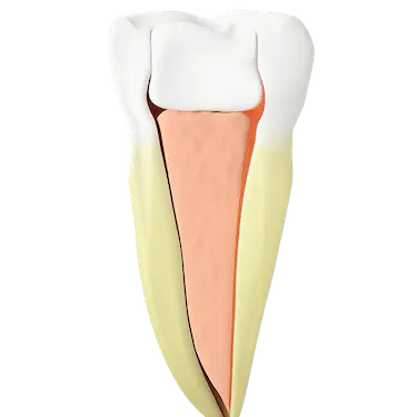 Diente restaurado con empaste o corona tras finalizar una endodoncia en Madrid