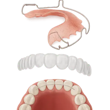 Imagen 3D de retenedores utilizados para mantener la posición de los dientes tras la ortodoncia