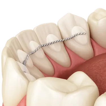 Retenedor fijo lingual adherido a los dientes anteriores para mantener la alineación dental