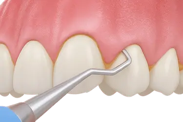 Curetaje dental para eliminar placa y sarro bajo la encía en Madrid