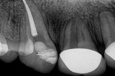 Radiografía de tratamiento de conducto en incisivo con una sola raíz en clínica dental de Madrid