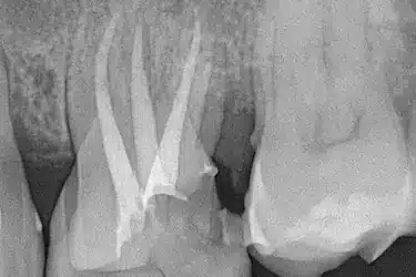 Radiografía de molar con varios conductos radiculares tras tratamiento dental conservador en Madrid