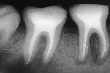 Radiografía dental de premolar con dos conductos tras tratamiento radicular en Madrid