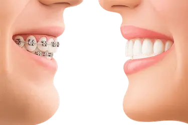 Comparativa de ortodoncia con y sin brackets en Murcia, Clínica Dr. Ferrer