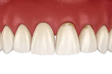 Manchas y retracción de encías por enfermedad periodontal tratadas en clínica dental de Murcia
