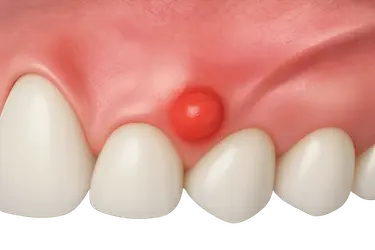 Absceso periodontal con inflamación e infección profunda en la encía, modelo dental 3D