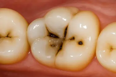 Caries dental profunda en muela que puede causar infección y absceso dental