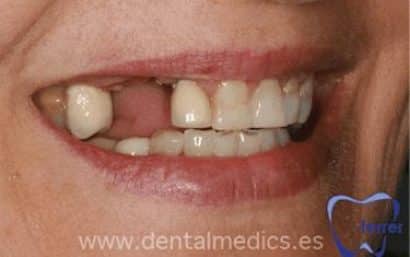 Antes