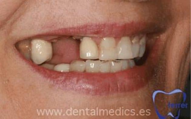 Antes