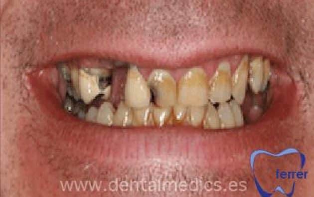 Antes