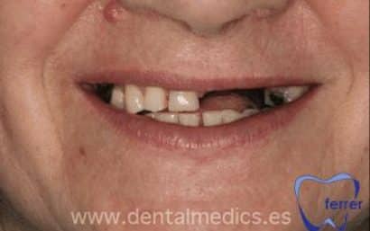 Antes