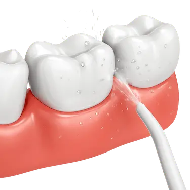 Desinfección de encías con irrigador tras curetaje dental en Madrid
