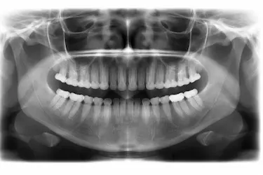 Radiografía panorámica para el diagnóstico completo en tratamientos de odontología conservadora