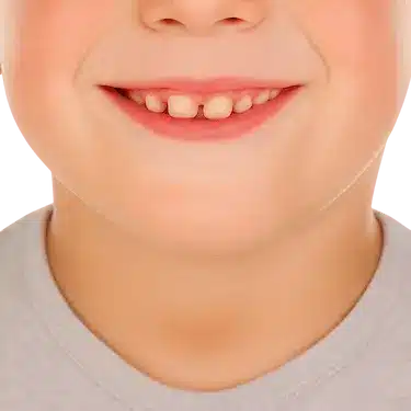 Sonrisa infantil con dientes separados visibles durante la erupción de los dientes definitivos