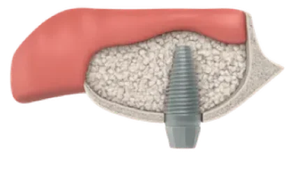 Elevación de seno maxilar para implantes dentales en Murcia