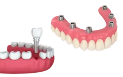 Tratamientos implantes dentales Madrid Dr. Ferrer