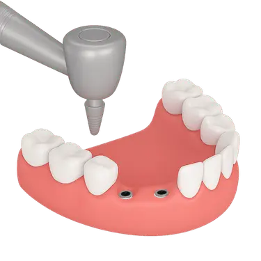 Colocación de un puente dental fijo sobre implantes dentales