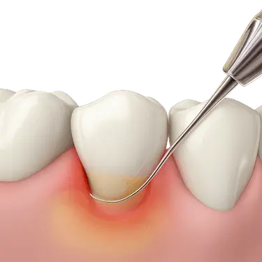 Ilustración 3D de curetaje dental eliminando sarro y placa bajo la encía inflamada