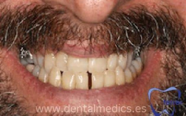 Antes