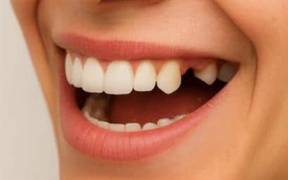 Sonrisa lateral con ausencia de molar superior que requiere elevación de seno maxilar