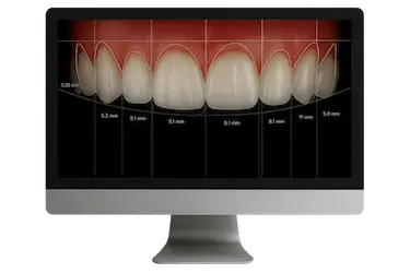 Diseño digital de sonrisa en Murcia con planificación estética dental por Dr. Ferrer