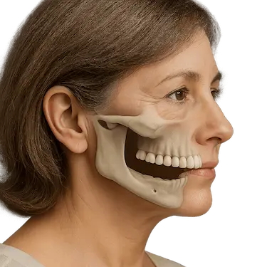 Perfil con pérdida ósea por ausencia de dientes y necesidad de implantes de carga inmediata