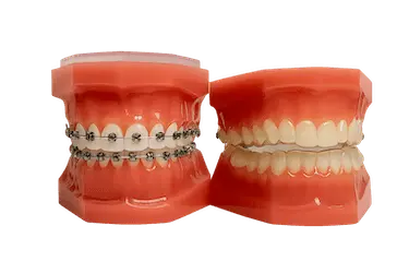Modelos dentales comparativos con y sin brackets que ilustran los tipos de ortodoncia