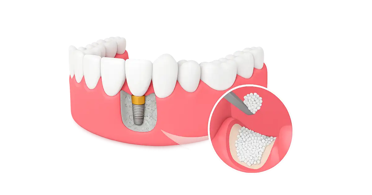 Injerto de hueso dental para implantes con material regenerativo en clínica Dr. Ferrer Madrid