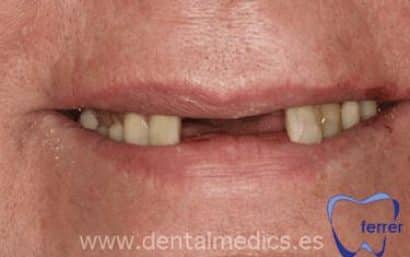 Antes